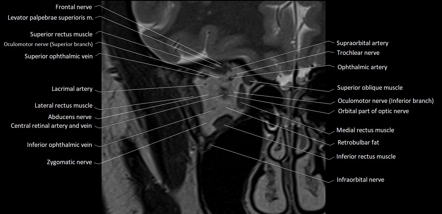 MRI Orbit coronal cross sectional anatomy image 10.webp